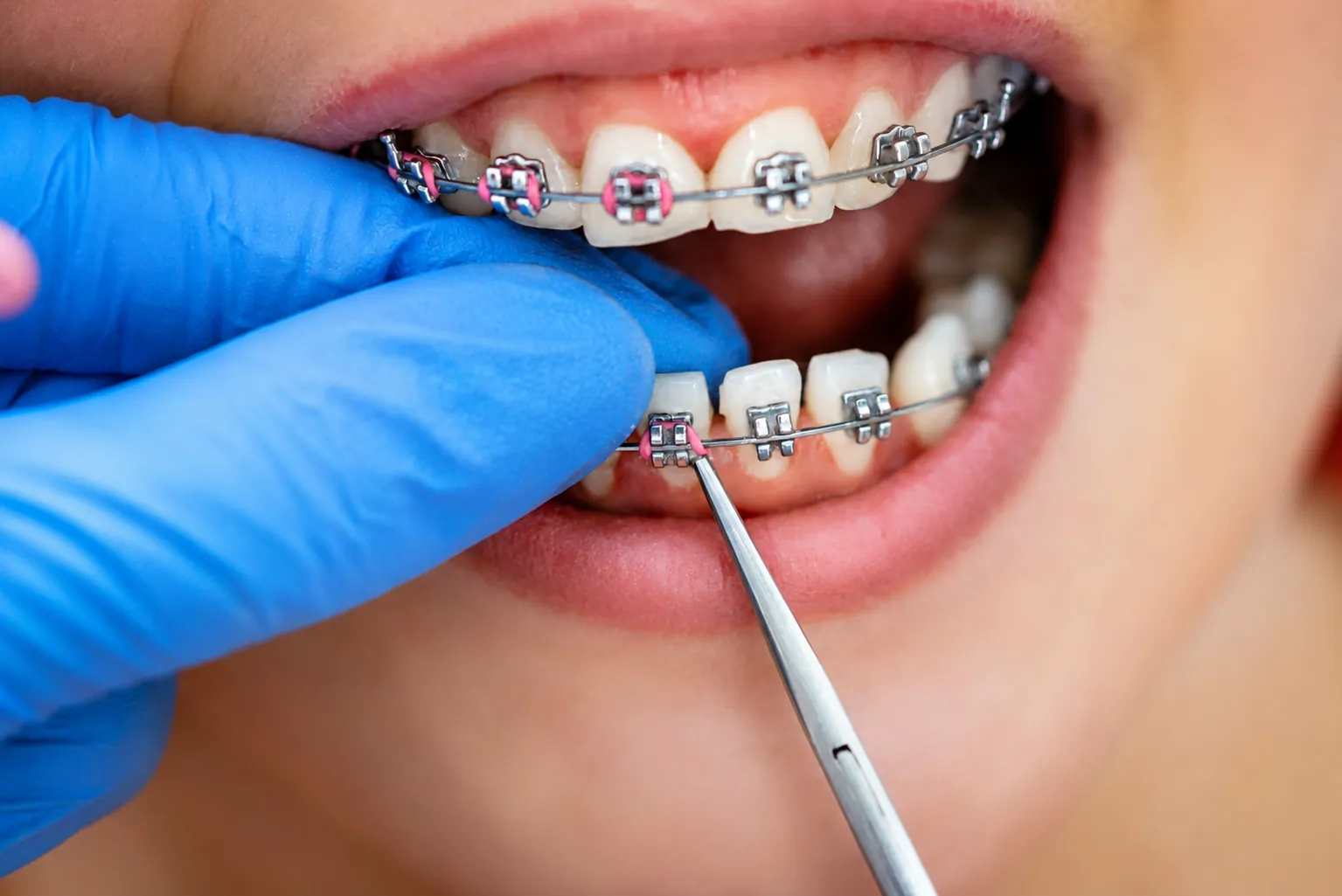 Ortho (Braces)